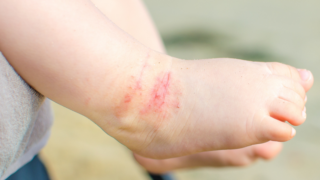 Skin Irritations - How to Prevent Them Using 100% Natural Products