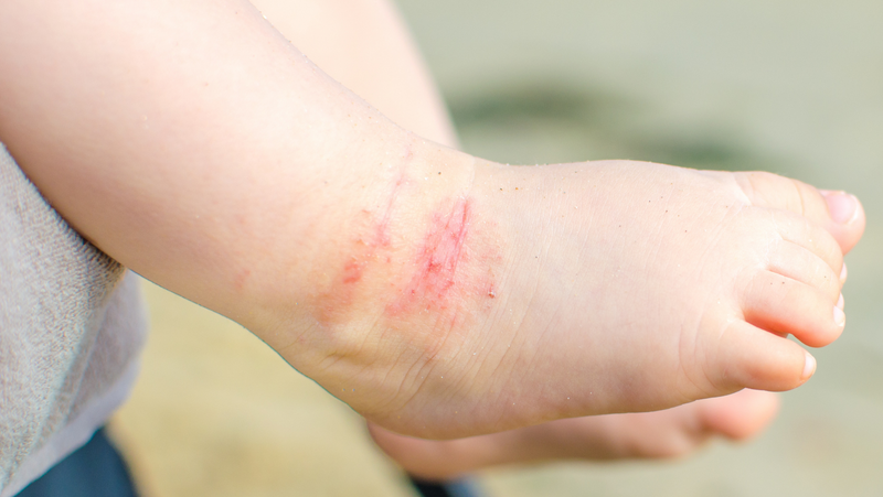 Skin Irritations - How to Prevent Them Using 100% Natural Products